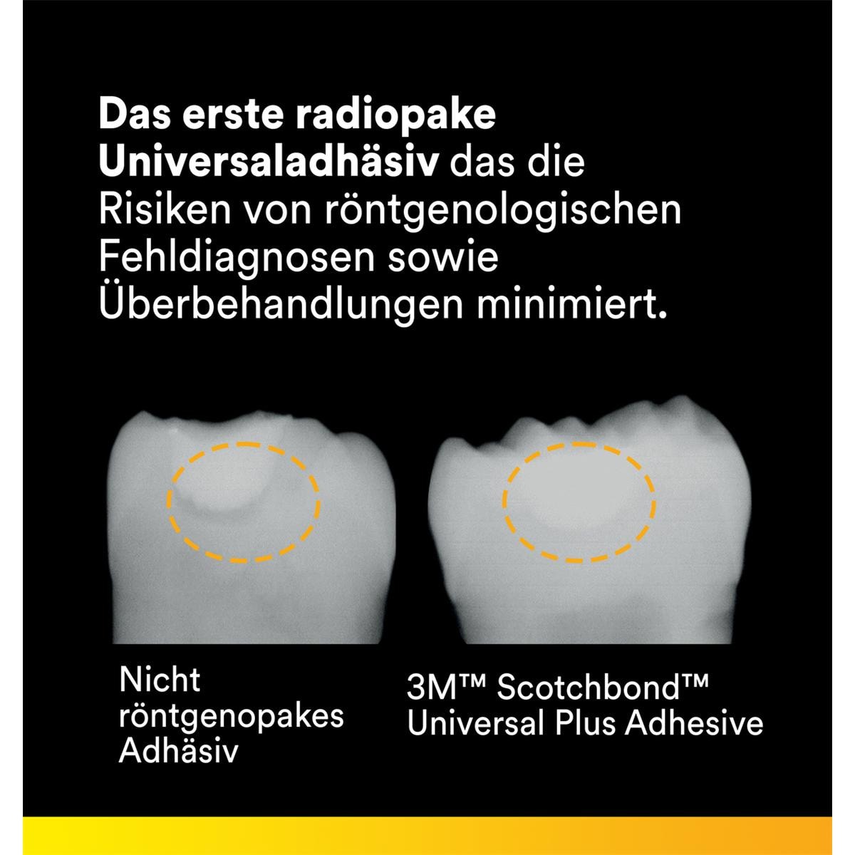 3M Scotchbond Universal Plus Adhäsiv, L-Pop - Nachfüllpackung - Packung 200 Stück