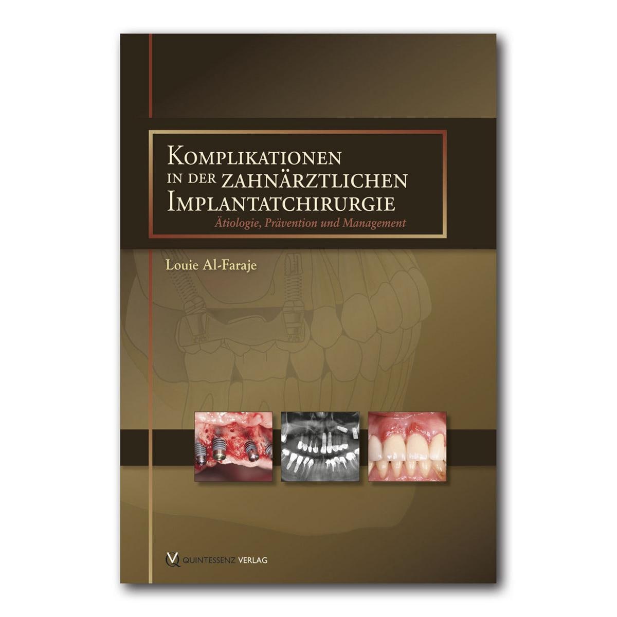 Komplikationen in der zahnärtzlichen Implantatchirurgie - Buch